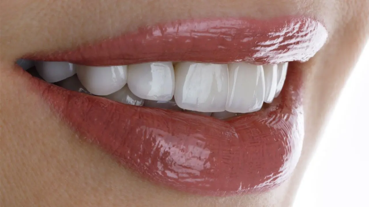 dentalveneers.webp